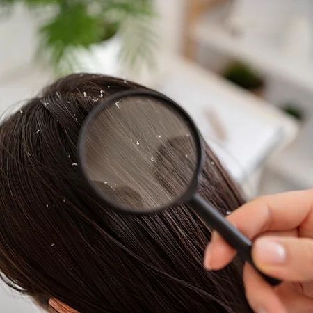 Anti- dandruff Treatment