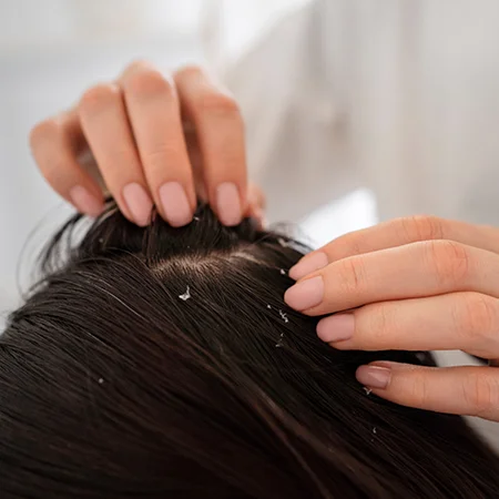 Anti - dandruff treatment