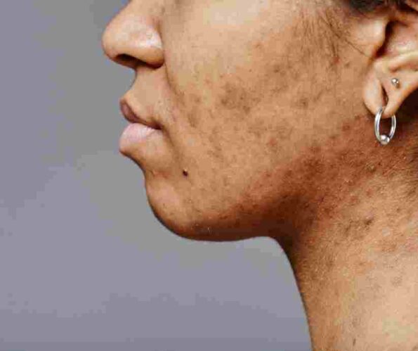 Pigmentation Treatment at Envi Aesthetics