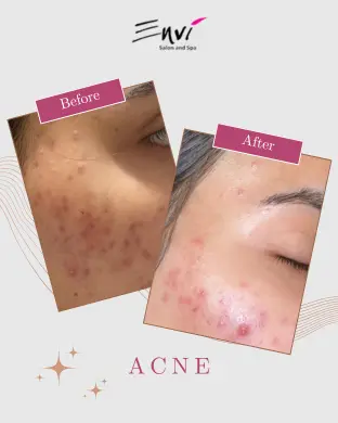 ENVI ACNE BEFORE AFTER