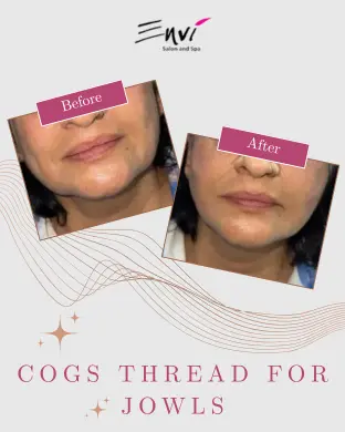 ENVI Cogs Thread for Jowls BEFORE AFTER