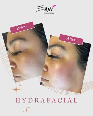 ENVI Hydrafacial BEFORE AFTER