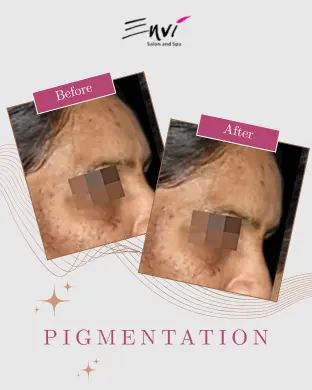 ENVI Pigmentation BEFORE AFTER