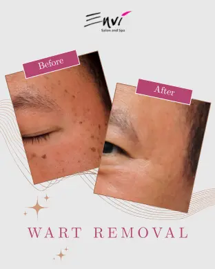 ENVI Wart Removal BEFORE AFTER